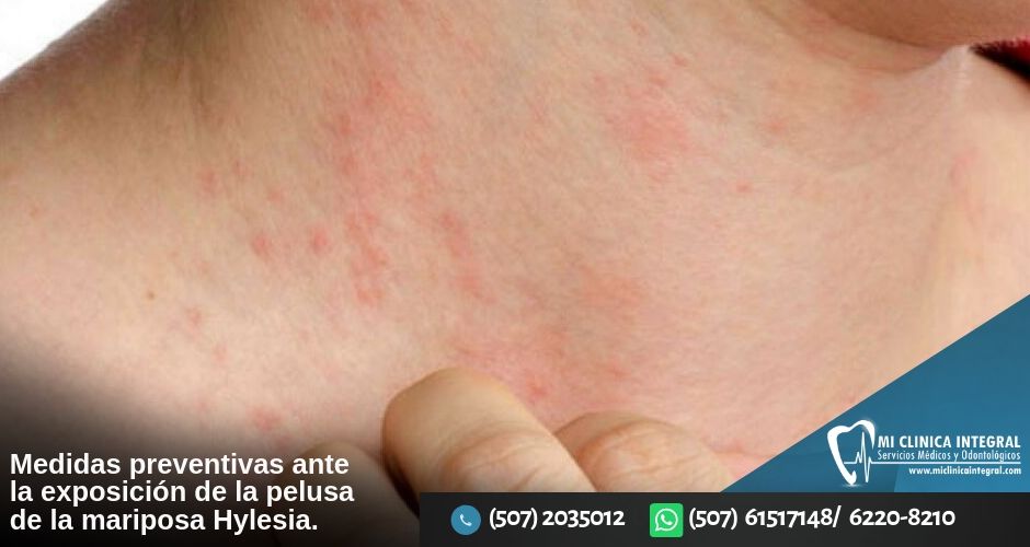 medidas-preventivas-y-recomendaciones-ante-la-exposicion-a-la-pelusa-de-la-mariposa-hylesia