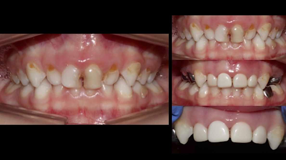 caries-severa-de-primera-infancia-en-odontopediatria