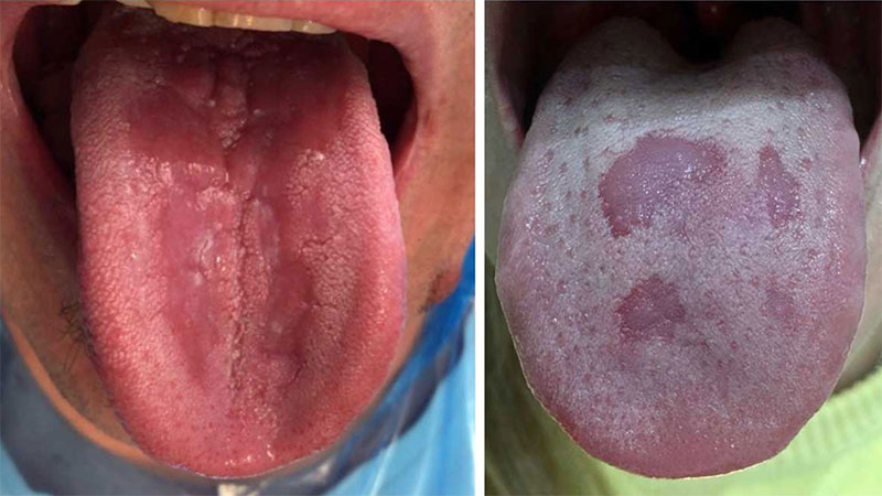 manifestaciones-orales-mas-comunes-de-covid-19